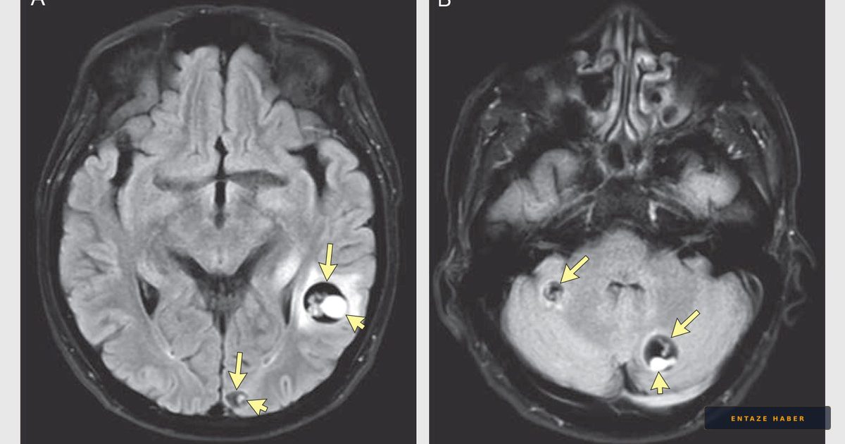 Living Nightmare: Tapeworm Larvae Found in Brain After Evacuation Center Stay